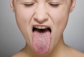 What is dry mouth?
