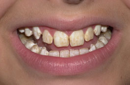 What are hypomineralised teeth?