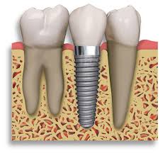 What is a dental implant?